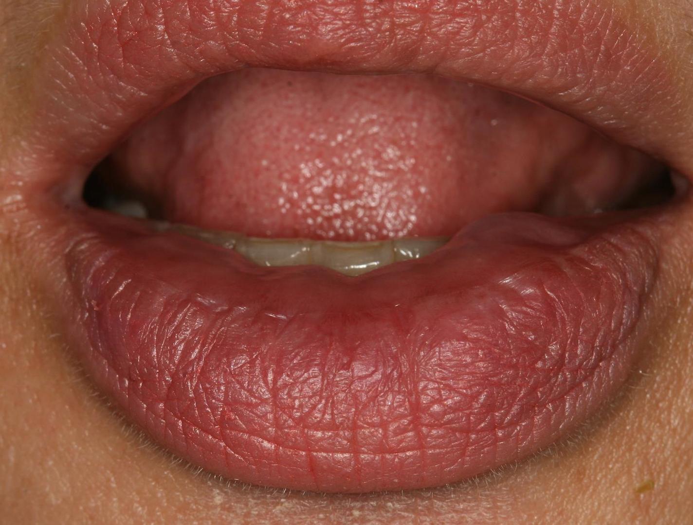 4个周的时间就能改善唇粘膜受损是真的吗？如何有效修复不反复？ - 知乎
