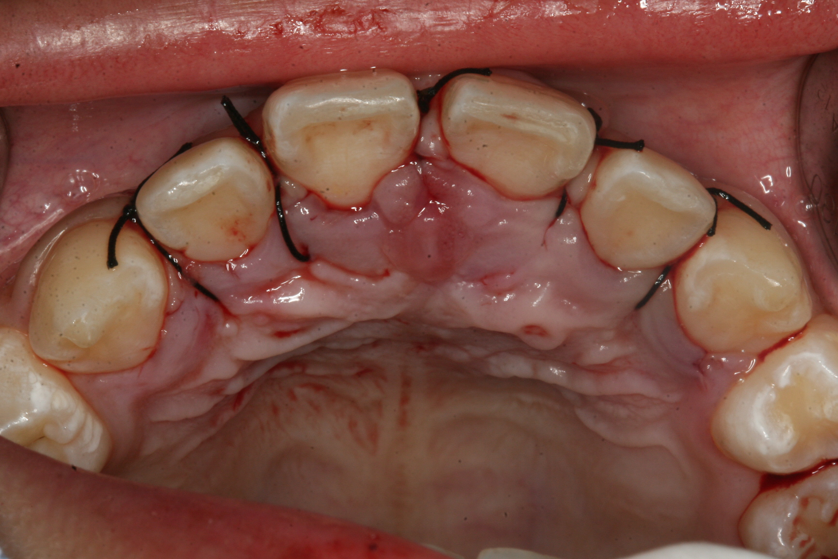 鼻腔直下に角状突起をもつ上顎正中完全埋伏逆性過剰歯の１例 森歯科医院